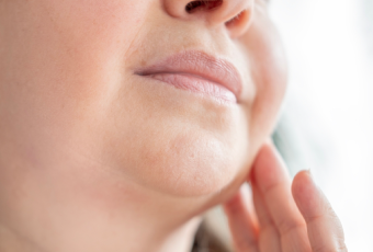 天生下巴短-新竹天鵝頸手術推薦