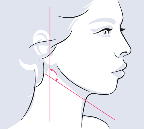 天鵝頸手術角度-新竹天鵝頸手術