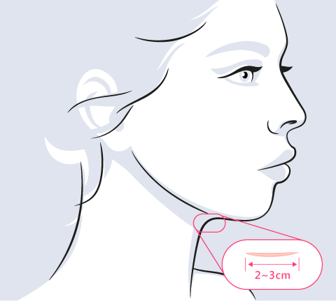 天鵝頸手術切口-新竹天鵝頸手術