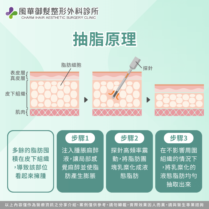 蘿蔔腿抽脂原理-蘿蔔腿抽脂