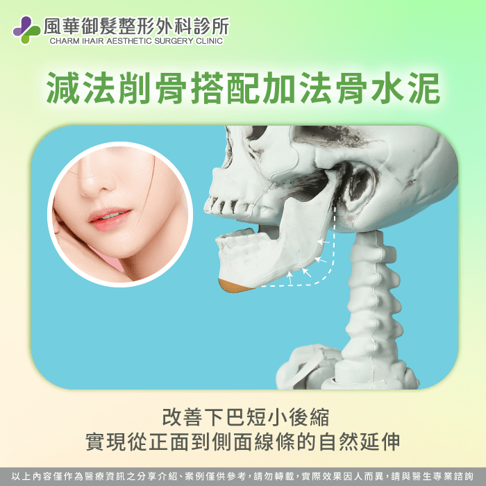 選擇下巴比例調適可實現從正面外觀到側面線條的自然延伸 下巴骨水泥手術美學定位-國字臉怎麼改善