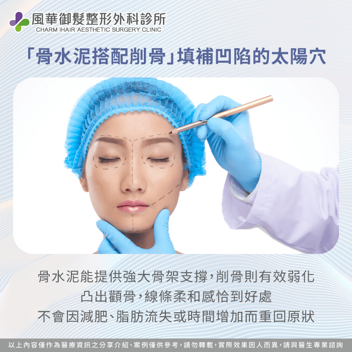 骨水泥搭配削骨手術-太陽穴凹陷整形