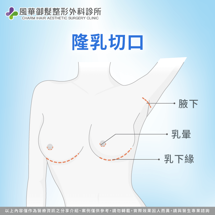 了解不同切口位置,影響疤痕隱蔽度與手術恢復過程 隆乳的切口-隆乳有幾種