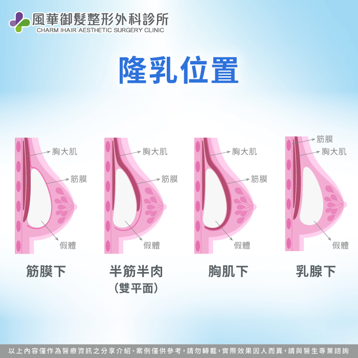 假體放置層次是決定術後外觀與觸感自然的關鍵 隆乳的位置-隆乳有幾種