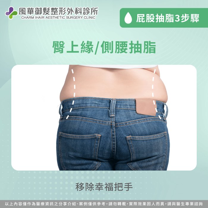 臀上緣/腰側抽脂-屁股可以抽脂嗎