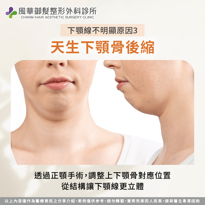 正顎手術調整上下顎骨位置,從骨骼結構改善下顎線不明顯 天生下顎骨後縮-下顎線不明顯