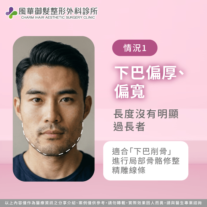 下巴偏厚偏寬適合下巴削骨手術介紹 下巴太長削骨-下巴太長截骨