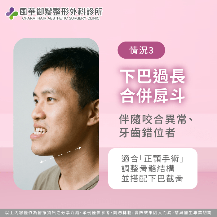 下巴過長合併戽斗適合正顎搭配截骨 下巴太長削骨-下巴太長截骨