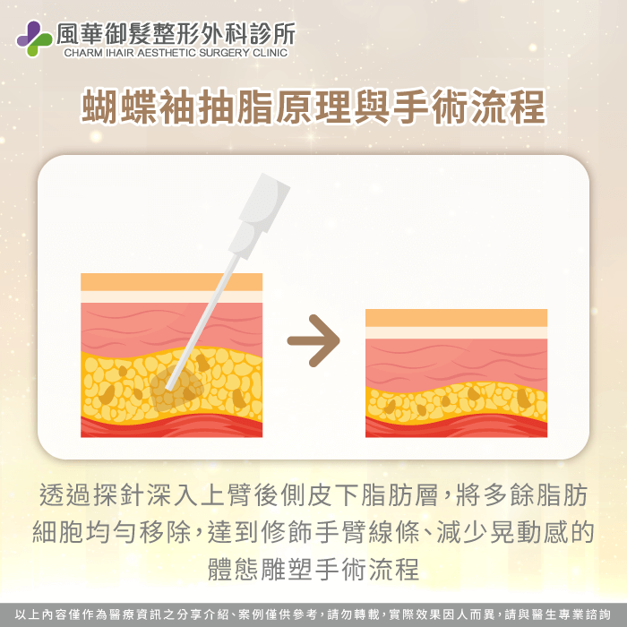 蝴蝶袖抽脂手術重點在於均勻抽除脂肪細胞,而非追求大量抽脂,目的是改善晃動感與比例線條 蝴蝶袖抽脂原理與手術流程-蝴蝶袖可以抽脂嗎