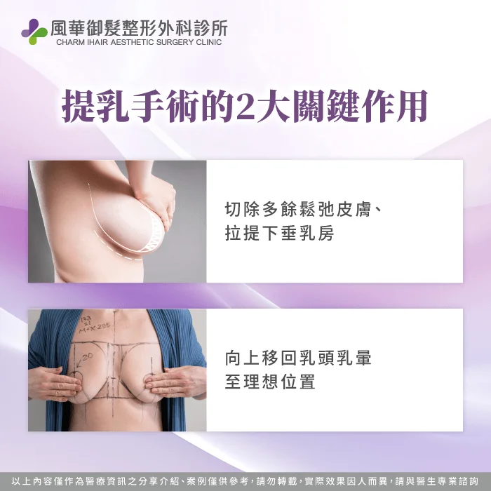 提乳關鍵:切除鬆弛皮膚、拉提下垂乳房、移回乳頭乳暈 提乳手術-提乳手術類型