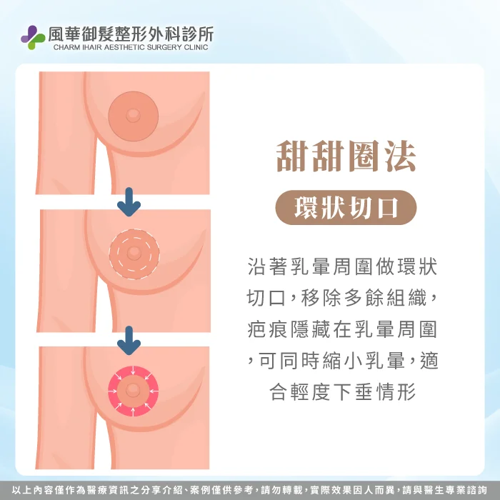 甜甜圈法-提乳手術類型