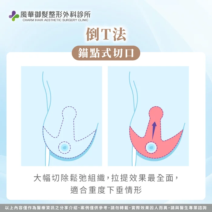 倒T法-提乳手術