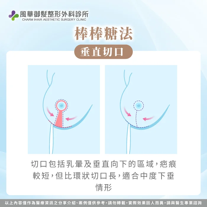 棒棒糖法-提乳手術類型