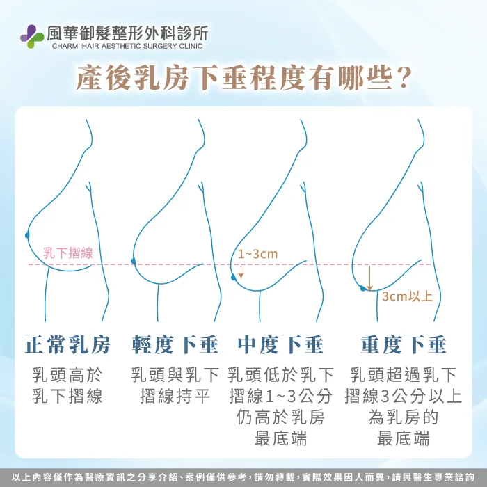產後乳房下垂程度有哪些-提乳手術
