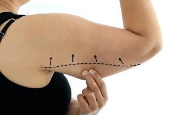 新竹手臂抽脂推薦-新竹手臂抽脂