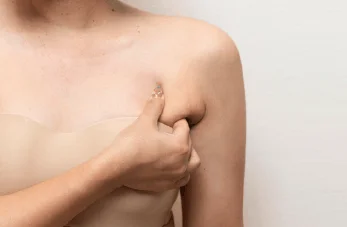 新竹手臂抽脂-新竹手臂抽脂手術