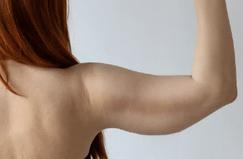 新竹手臂抽脂推薦-新竹手臂抽脂手術