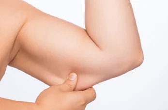 新竹手臂抽脂-新竹手臂抽脂手術