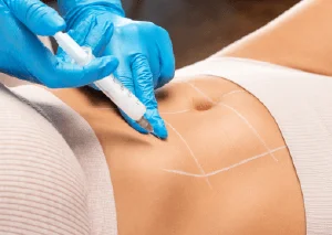 新竹自體脂肪豐臉-新竹自體脂肪豐臉推薦