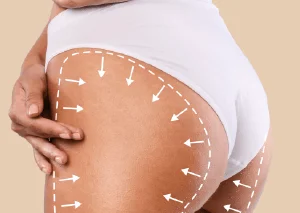 新竹自體脂肪豐臉推薦-新竹自體脂肪豐臉