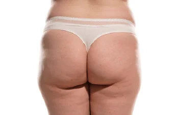 新竹臀部抽脂-新竹臀部抽脂推薦