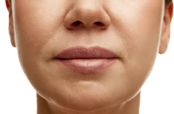 新竹嘴邊肉抽脂-新竹臉部抽脂推薦