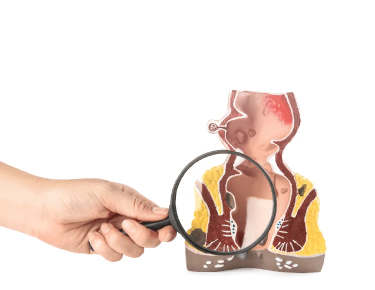 痔瘡若反覆出血、脫垂或疼痛影響生活,應由醫師評估病況分級,選擇適合的治療與手術方式。 新竹痔瘡診所-竹北痔瘡手術推薦
