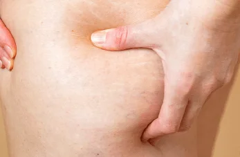 局部大腿抽脂-新竹大腿抽脂