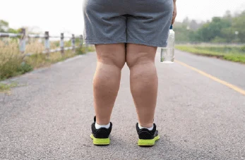 象腿-腿部抽脂-新竹腿部抽脂推薦