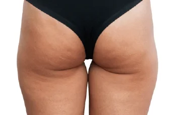 假胯寬抽脂-新竹大腿抽脂