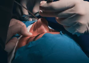 鼻翼手術推薦-新竹鼻翼縮小手術