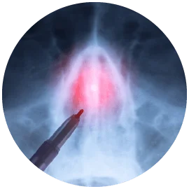 鼻中隔手術-新竹鼻頭整形手術