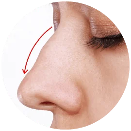 駝峰鼻手術-新竹鼻頭整形手術-