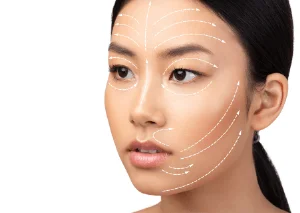 新竹臉部埋線推薦-新竹鼻唇溝填補