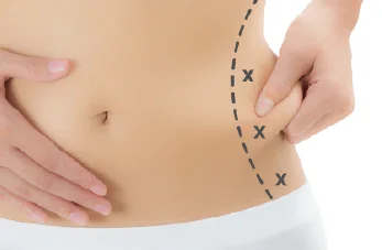 後腰抽脂-新竹腰腹抽脂